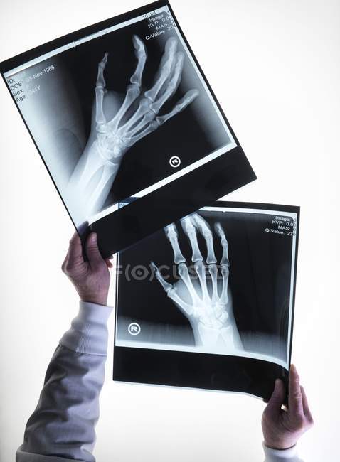 Immagine a raggi X delle ossa della mano — Foto stock