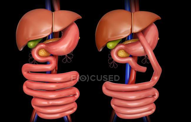Процедура шунтирования желудка — стоковое фото