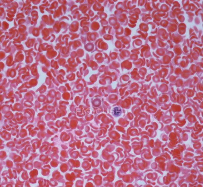 Micrografía ligera de glóbulos rojos (eritrocitos, rojos) en un vaso sanguíneo
. - foto de stock