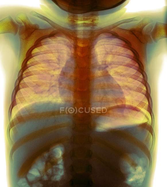 Monete inghiottite nell'esofago — Foto stock