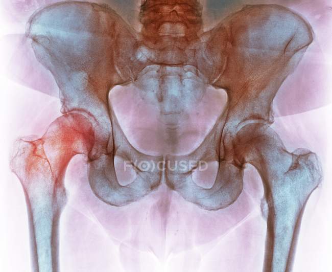 Cadera antes de la cirugía de reemplazo de cadera, rayos X - foto de stock