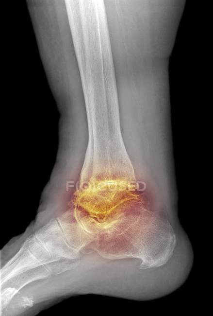 Osteoartrite grave do tornozelo — Fotografia de Stock