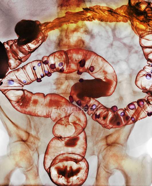 Colon of a patient with diverticulitis — Stock Photo