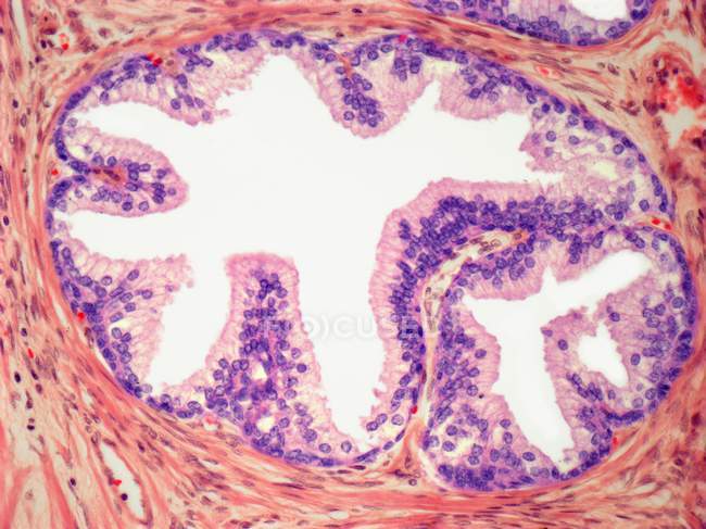 Micrografia de luz de uma seção através do folículo de uma glândula de tireóide afetada pela doença de Grave . — Fotografia de Stock