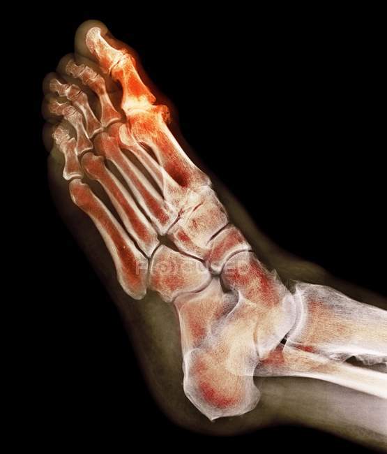 Deformação degenerativa do pé, raio-X — Fotografia de Stock