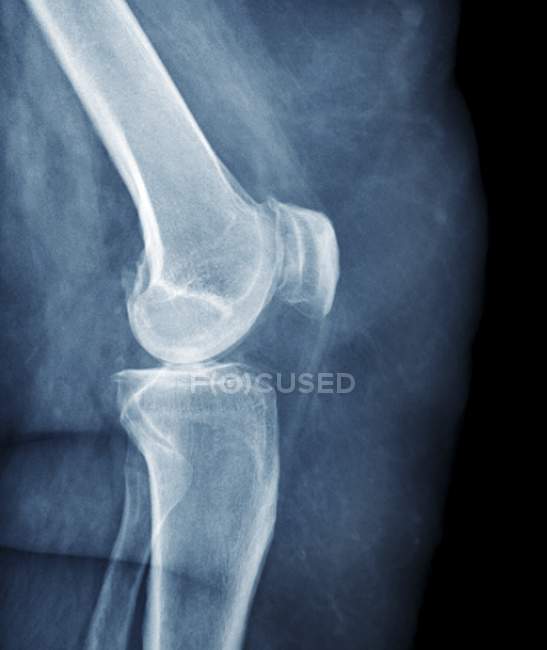 Ginocchio di paziente obeso con artrite — Foto stock