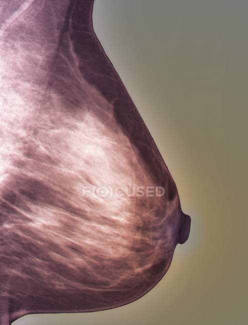 Цветной рентген левой груди (маммограмма) 27-летнего пациента
. — стоковое фото