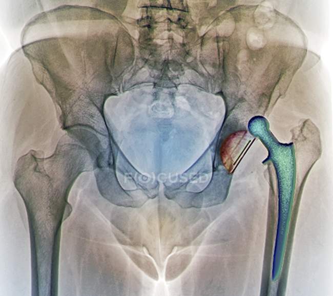Sostituzione lussata dell'anca — Foto stock