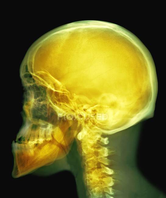 Raggi X del cranio di un maschio adulto — Foto stock