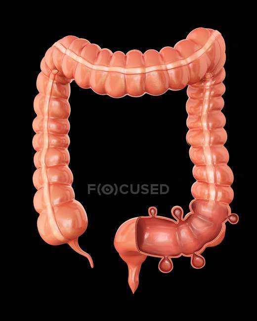 Large intestine showing diverticulitis — Stock Photo