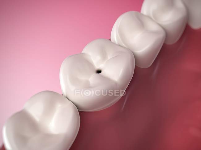 La carie dentaire humaine — Photo de stock
