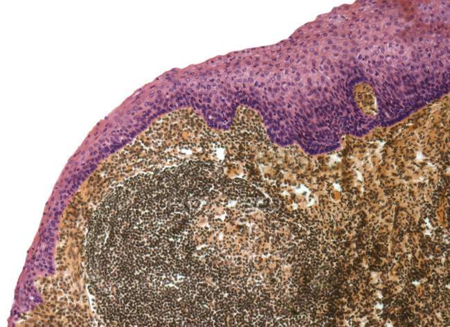 Micrografo leggero di una sezione attraverso la superficie di una tonsilla che mostra l'epitelio squamoso stratificato (rosa) e il tessuto linfoide sottostante . — Foto stock