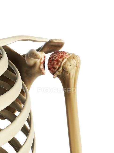 Visualización visual del hombro artrítico - foto de stock