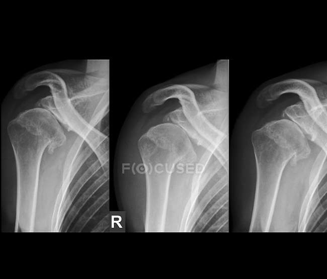 X-rays of the right shoulder of a 36 year old patient that has repeatedly dislocated the joint. — Stock Photo
