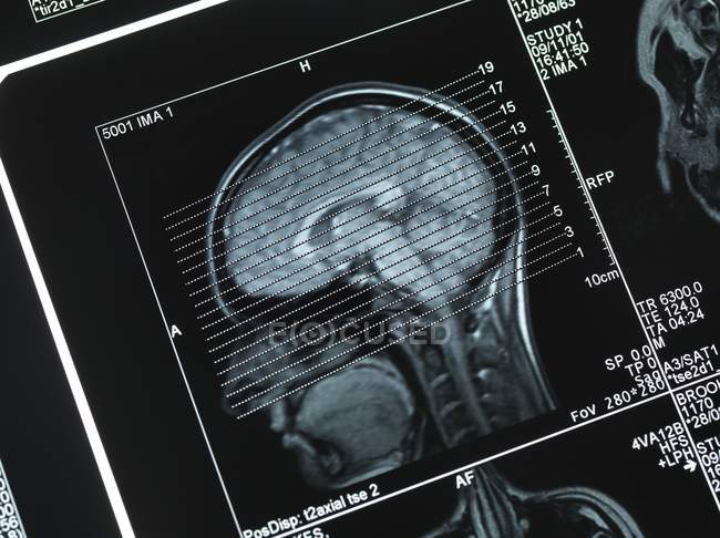 Coupe transversale du cerveau humain — Photo de stock