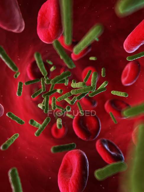 Infección bacteriana que se propaga en el torrente sanguíneo - foto de stock