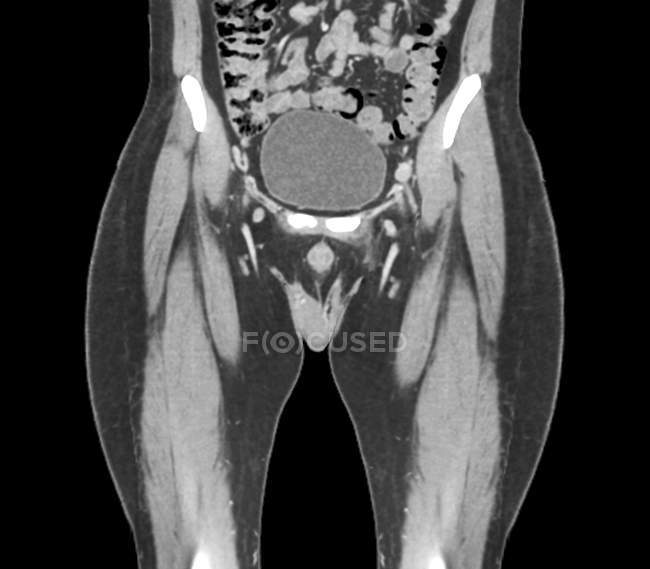 Tomodensitométrie (TDM) de la vessie entière saine (ovale) d'un patient de 45 ans . — Photo de stock