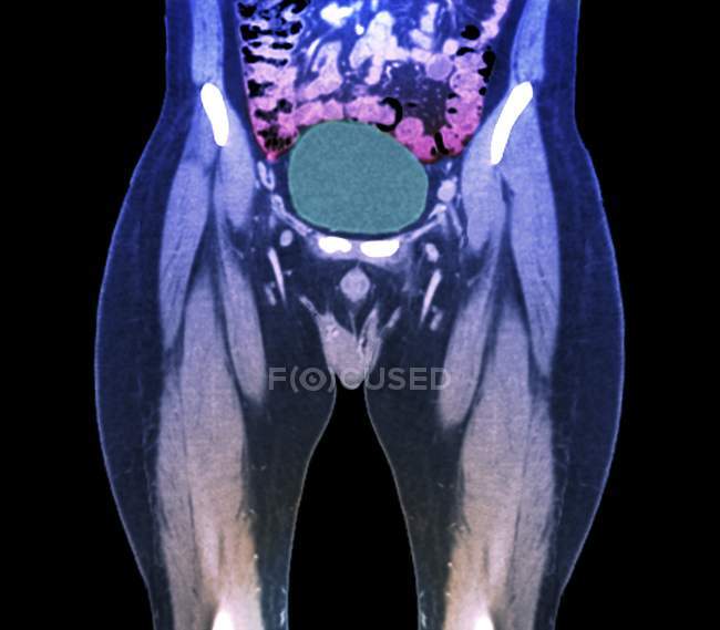 Кольорові комп'ютерної томографії (Коннектикут) сканування здорового повного сечового міхура (зелений) 45-річний пацієнта. — стокове фото