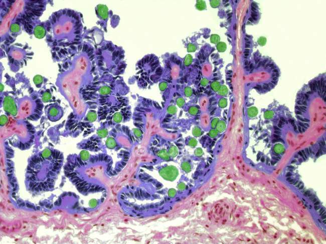 Ducto biliar hepático infectado com protozoários cocídios — Fotografia de Stock