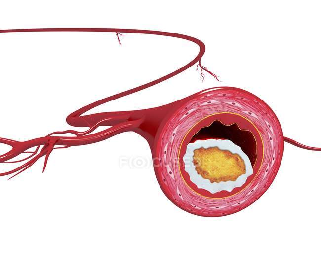Атеросклероз и суженная артерия — стоковое фото