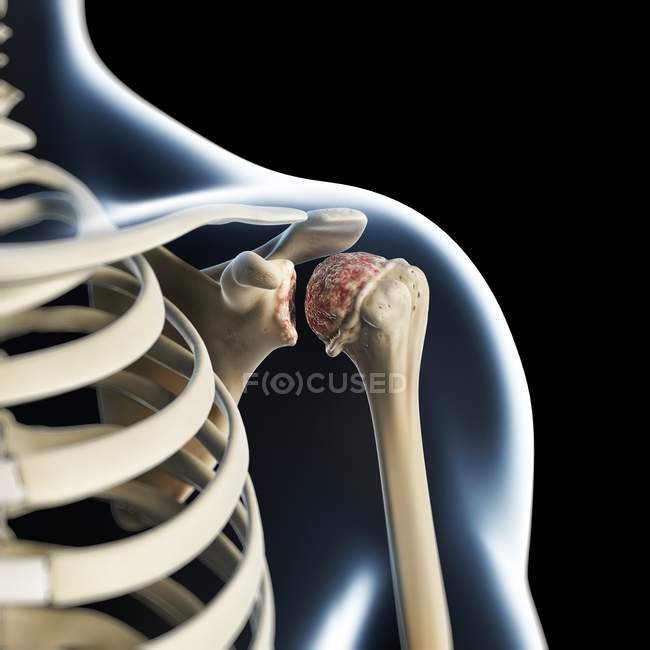 Renderização visual do ombro artrítico — Fotografia de Stock