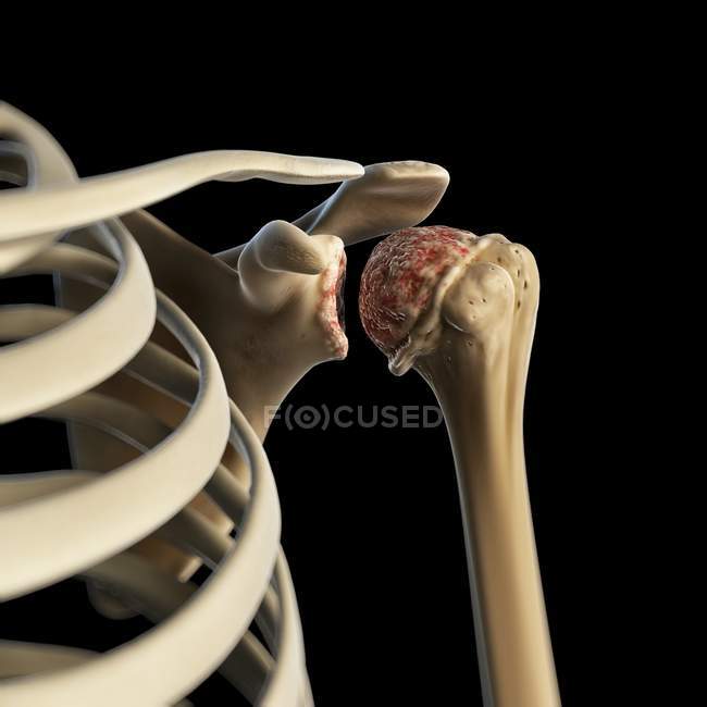 Visualización visual del hombro artrítico - foto de stock