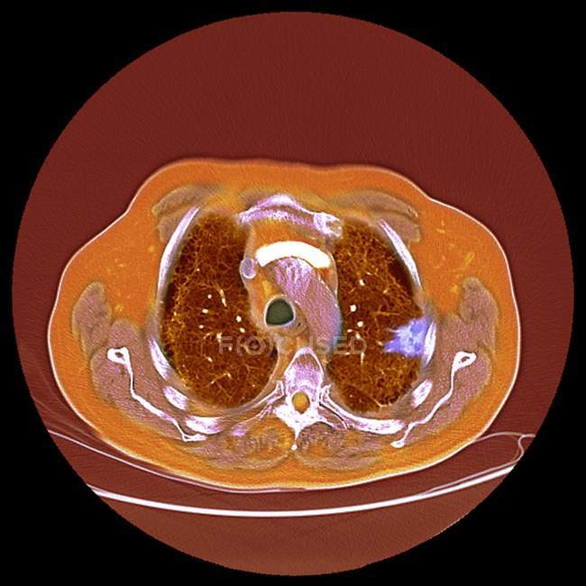 Tomodensitométrie (TDM) colorée d'une section de la poitrine d'un homme de 76 ans atteint d'une tumeur maligne (cancéreuse) (brillante, droite) des bronches
. — Photo de stock