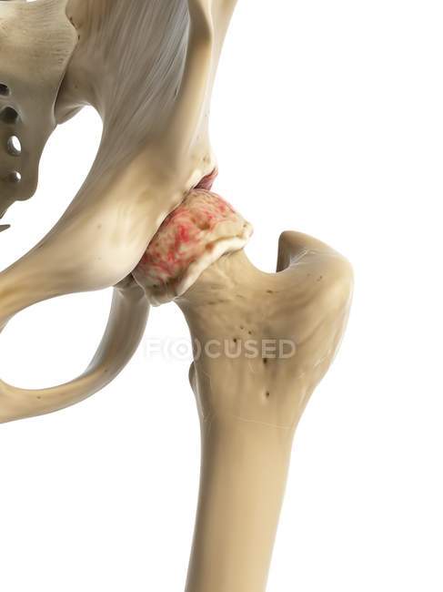Arthritic inflammation of hip joint — Stock Photo