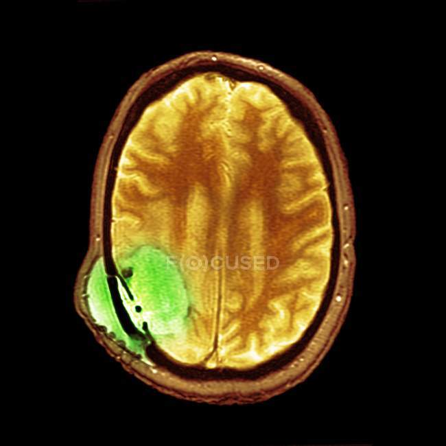 Normale cervello umano — Foto stock