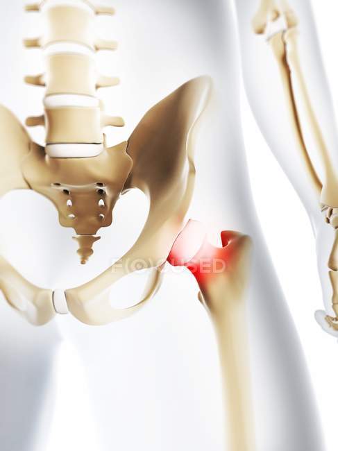 Focus of inflammation localized in hip joint — Stock Photo