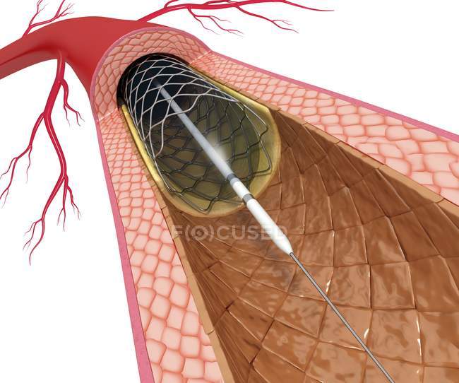 Procedura di angioplastica con palloncino — Foto stock
