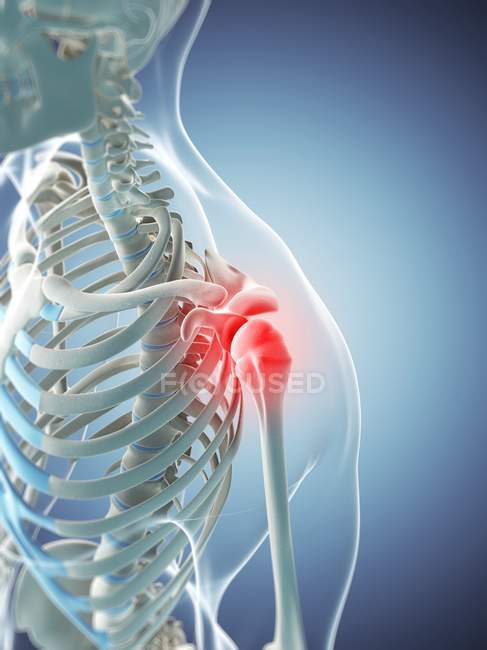 Foco da inflamação localizada na articulação do ombro — Fotografia de Stock