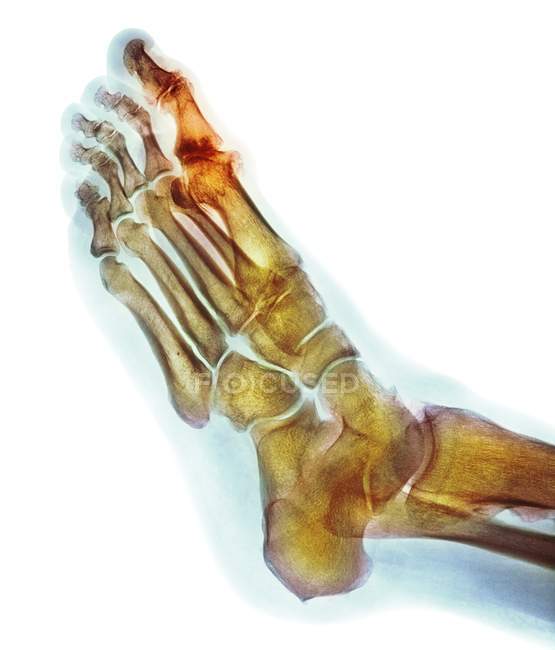 Déformation dégénérative du pied, rayons X — Photo de stock