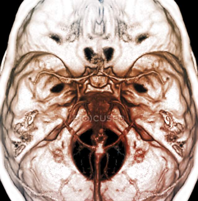 Arteries of the human brain — Stock Photo