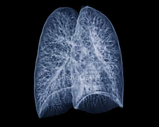 Tomografía computarizada (TC) 3D coloreada de los pulmones sanos de un paciente de 30 años
. - foto de stock