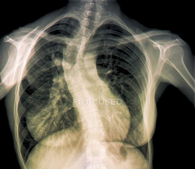 Radiografía coloreada de la escoliosis de la columna vertebral - foto de stock