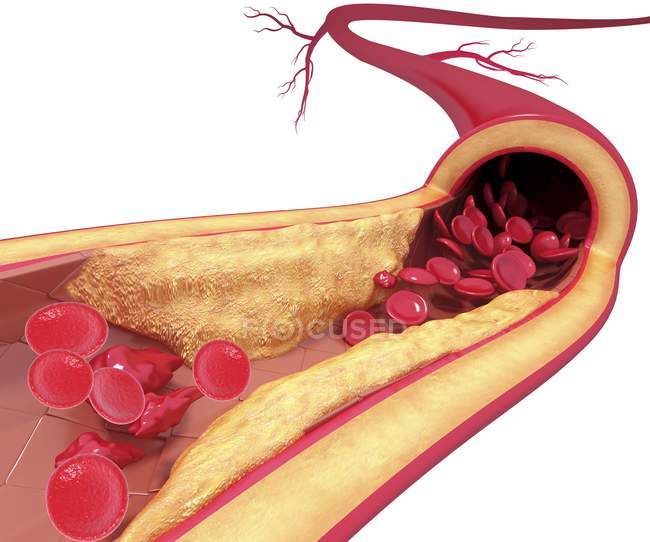 Cholesterin-Plaque führt zu Arteriosklerose — Stockfoto