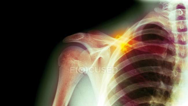 Coloured X-ray of a 16 year old male with a fractured clavicle (collar bone). — Stock Photo