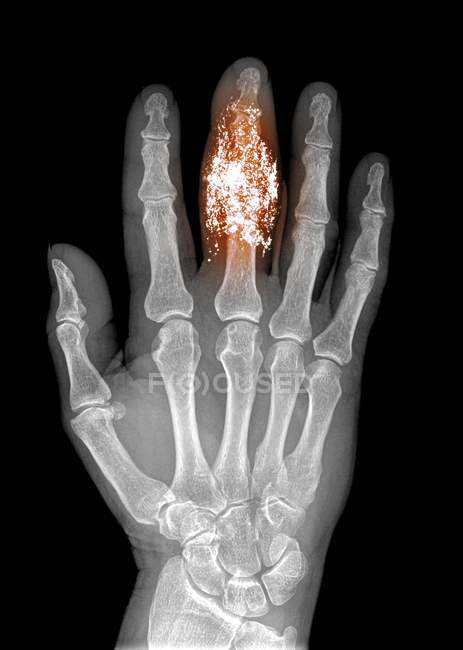 Сторонні тіла в палець — стокове фото