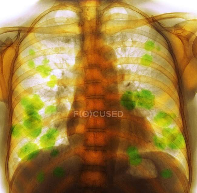 Farbige Röntgenaufnahme der Brust einer 52-jährigen Patientin mit metastasierendem (sekundärem) Lungenkrebs (gelb)). — Stockfoto