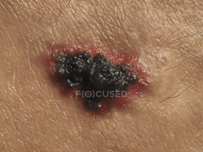 Патологія раку шкіри — стокове фото