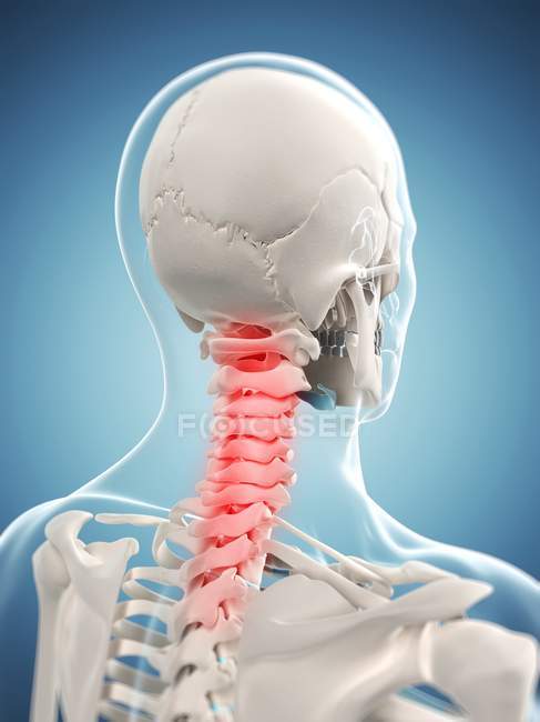 Dolor localizado en región cervical de la columna vertebral - foto de stock