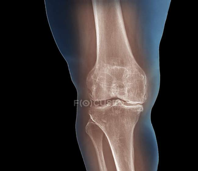 Дегенеративный артрит колена — стоковое фото
