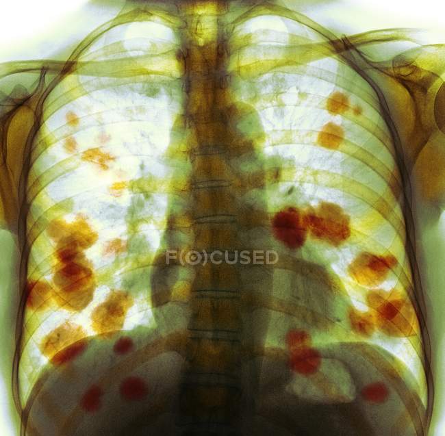 Farbige Röntgenaufnahme der Brust einer 52-jährigen Patientin mit metastasierendem (sekundärem) Lungenkrebs (gelb)). — Stockfoto