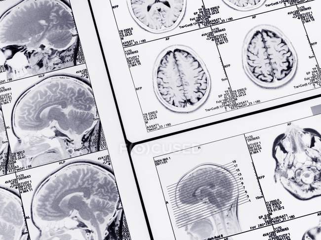 Serie von MRI-Gehirnscans — Stockfoto