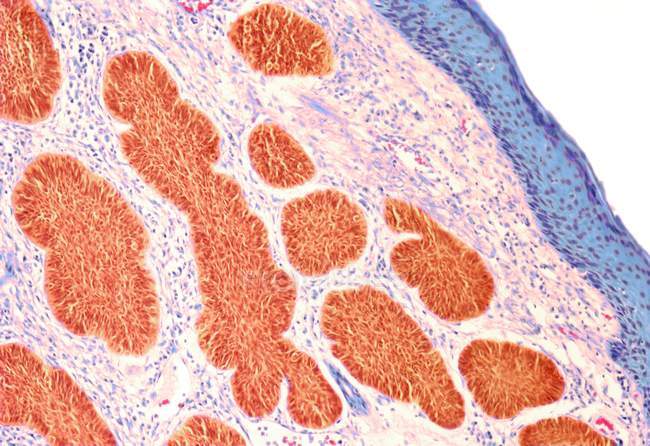 Базально-клеточный рак — стоковое фото