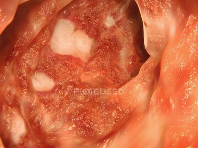 Colon affected by ulcerative colitis — Stock Photo