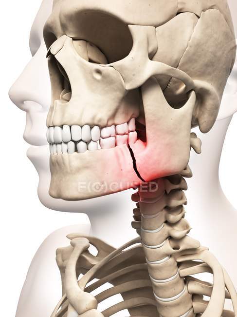 Сломанная челюсть — стоковое фото