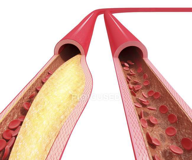 Anatomia patologica dell'aterosclerosi — Foto stock