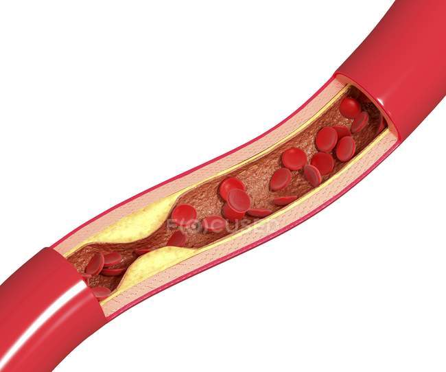 Plaque de cholestérol conduisant à l'athérosclérose — Photo de stock